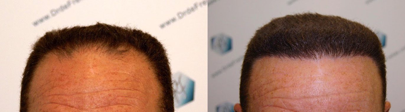 Caso real de trasplante capilar FUE con alopecia tipo IV - V 1 tc 1 Caso real de trasplante capilar FUE con alopecia tipo IV - V