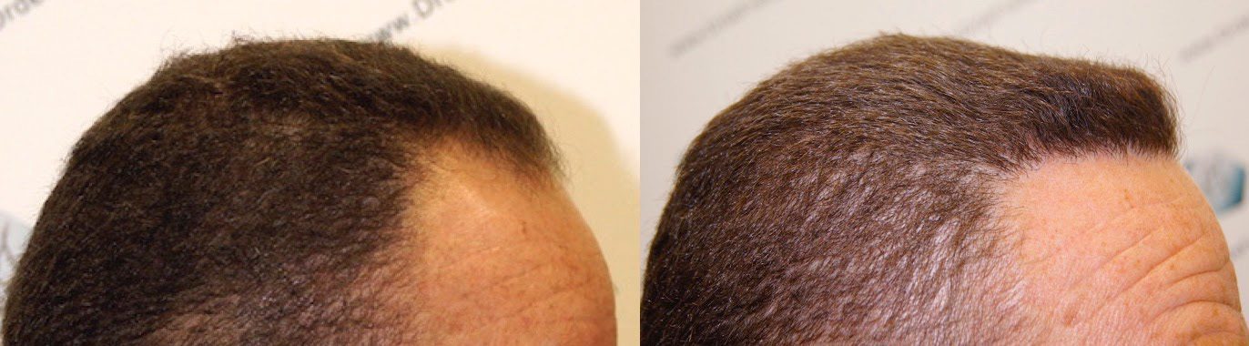 Caso real de trasplante capilar FUE con alopecia tipo IV - V 3 tc 2 Caso real de trasplante capilar FUE con alopecia tipo IV - V