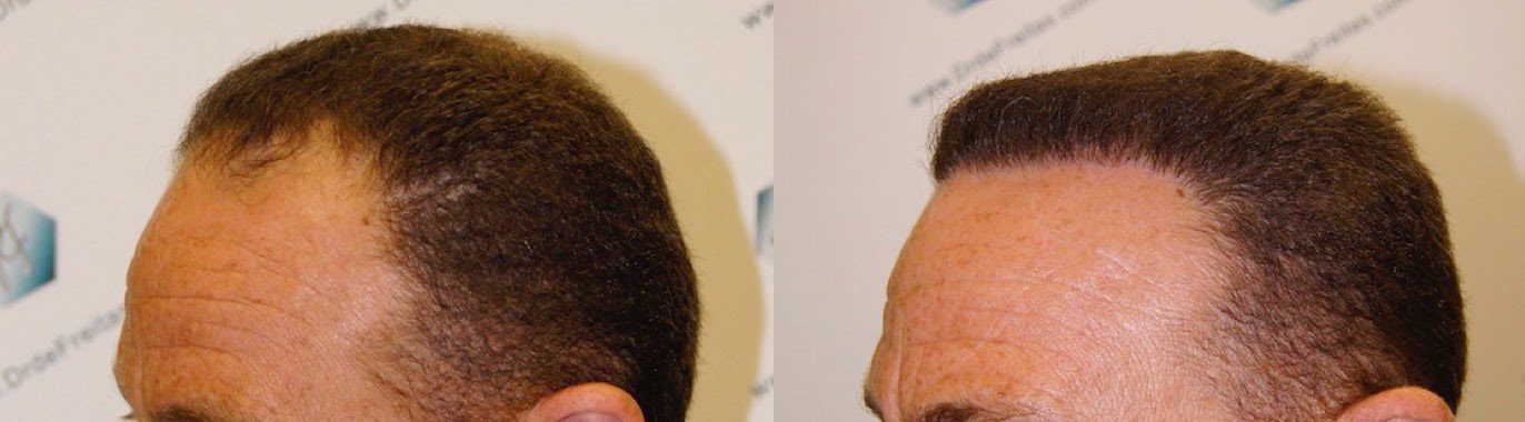 Caso real de trasplante capilar FUE con alopecia tipo IV - V 2 tc 3 Caso real de trasplante capilar FUE con alopecia tipo IV - V