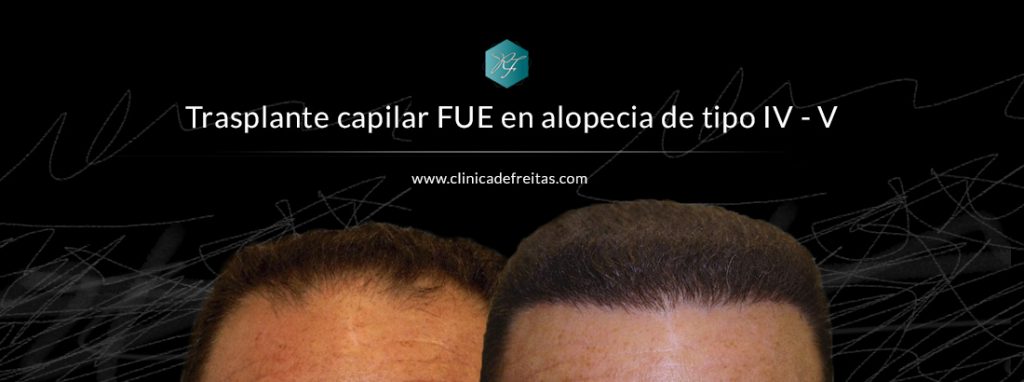 foto blog trasplante capilar alopecia IV V