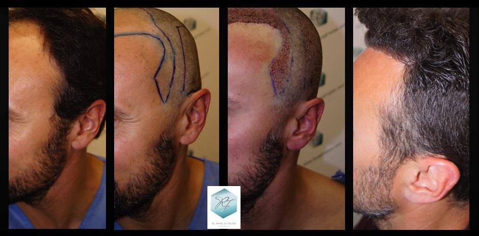 Injerto Capilar Técnica FUE 1.683 Grafts (Pelos 3705) 58 ANTES-Y-DESPUES-TRASPLANTE-CAPILAR