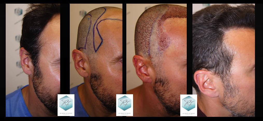 Injerto Capilar Técnica FUE 1.683 Grafts (Pelos 3705) 60 ANTES-Y-DESPUES-TRASPLANTE-CAPILAR