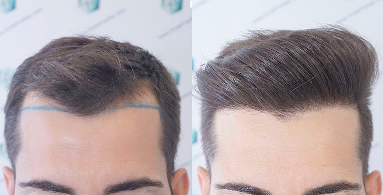 Láser Capilar Antes Y Después Fotos de Trasplantes Capilares | Dr de Freitas 🥇🥇