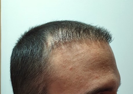 Consecuencias De Un Trasplante Capilar Mal Realizado Clinica De Freitas