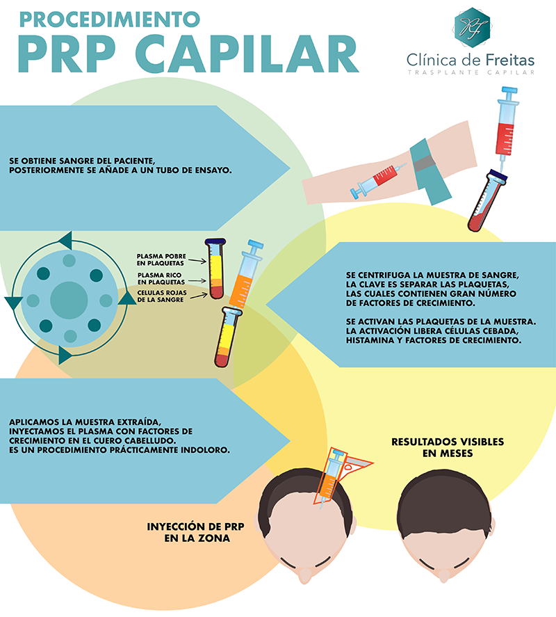 Qué es prp capilar y funciona? | de Freitas