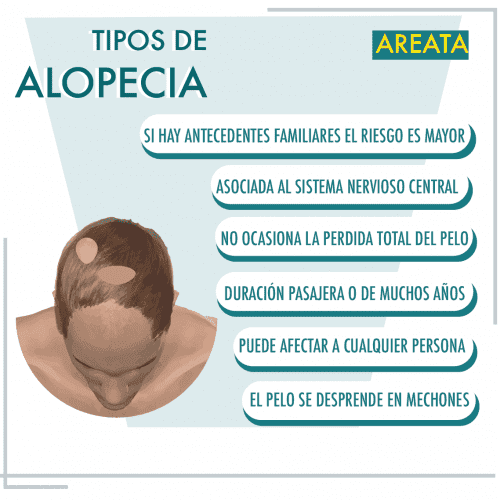 Psicologicamente Lustre televisor Alopecia areata | Clínica de Freitas