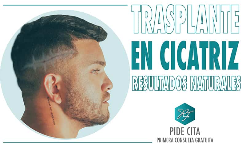 trasplante capilar en cicactrices