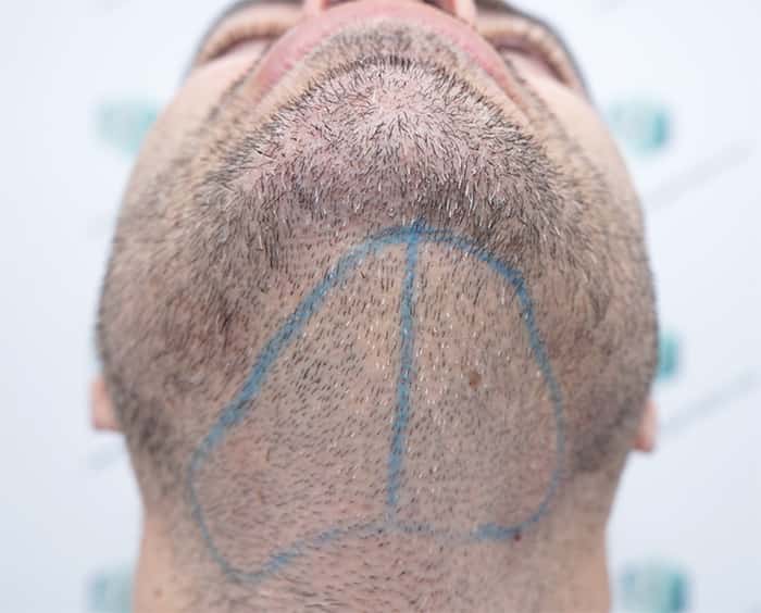 🥇Clinica Capilar en Valencia Clínica de Freitas