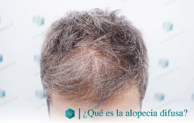 tratar la alopecia difusa