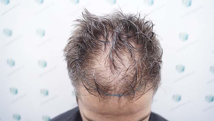 como tratar la alopecia difusa