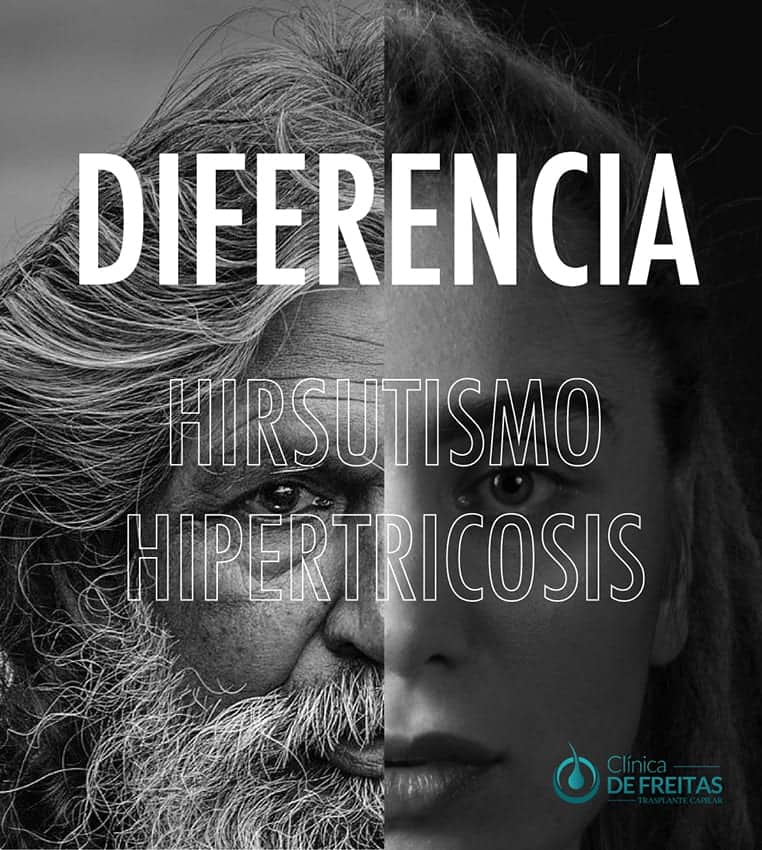 Diferencias del hirsutismo y la hipertricosis