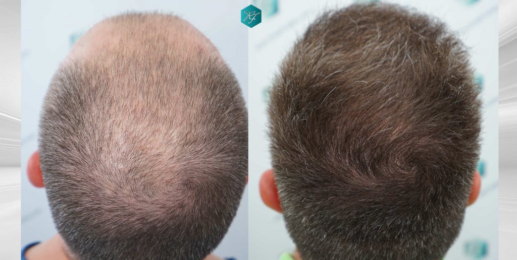 alopecia en la coronilla antes y después
