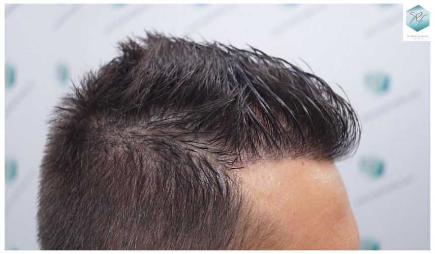 Injerto Capilar Técnica FUE 2762 Grafts (6703 Pelos) 26 trasplante de pelo