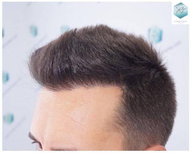 Injerto Capilar Técnica FUE 2762 Grafts (6703 Pelos) 18 trasplante de pelo