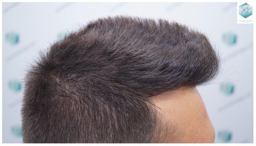 Injerto Capilar Técnica FUE 2762 Grafts (6703 Pelos) 15 trasplante de pelo