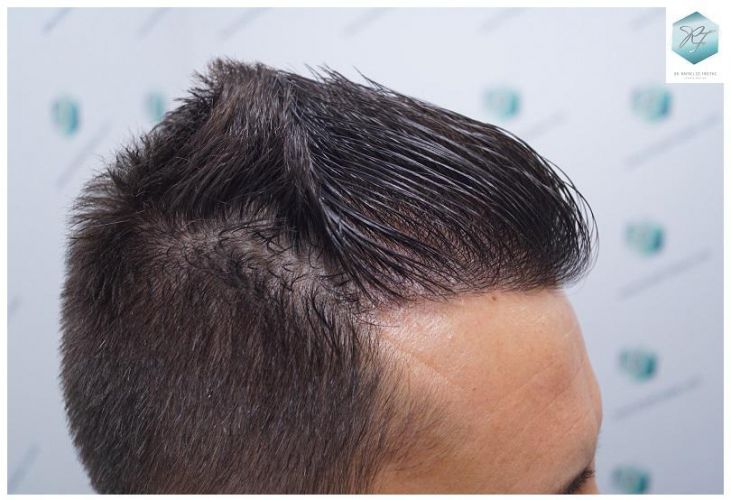 Injerto Capilar Técnica FUE 2762 Grafts (6703 Pelos) 25 trasplante de pelo