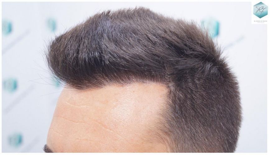 Injerto Capilar Técnica FUE 2762 Grafts (6703 Pelos) 19 trasplante de pelo