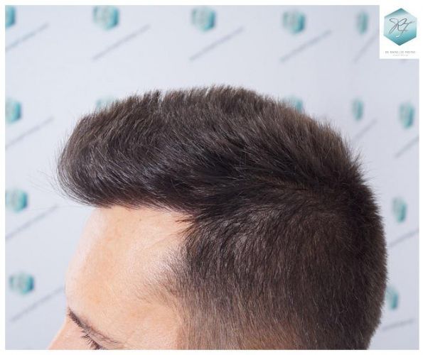 Injerto Capilar Técnica FUE 2762 Grafts (6703 Pelos) 17 trasplante de pelo