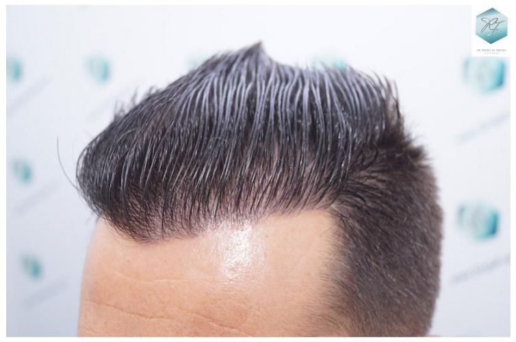 Injerto Capilar Técnica FUE 2762 Grafts (6703 Pelos) 27 trasplante de pelo