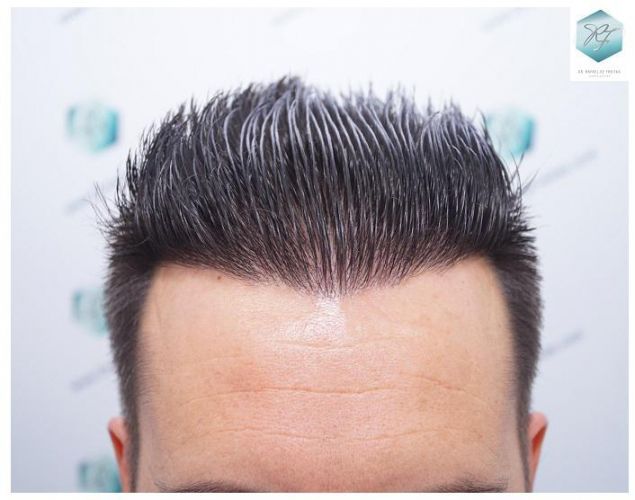 Injerto Capilar Técnica FUE 2762 Grafts (6703 Pelos) 22 trasplante de pelo