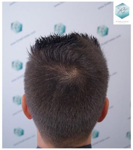 Injerto Capilar Técnica FUE 2762 Grafts (6703 Pelos) 29 trasplante de pelo