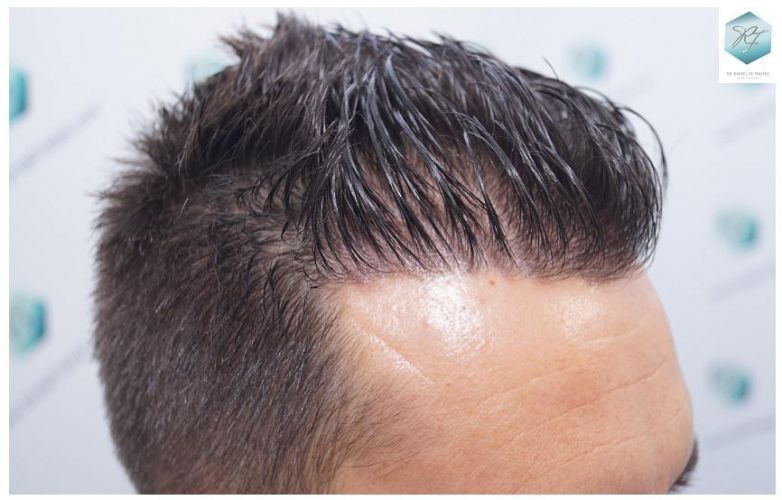 Injerto Capilar Técnica FUE 2762 Grafts (6703 Pelos) 24 trasplante de pelo
