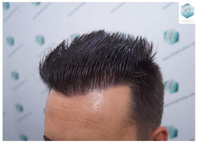 Injerto Capilar Técnica FUE 2762 Grafts (6703 Pelos) 16 trasplante de pelo