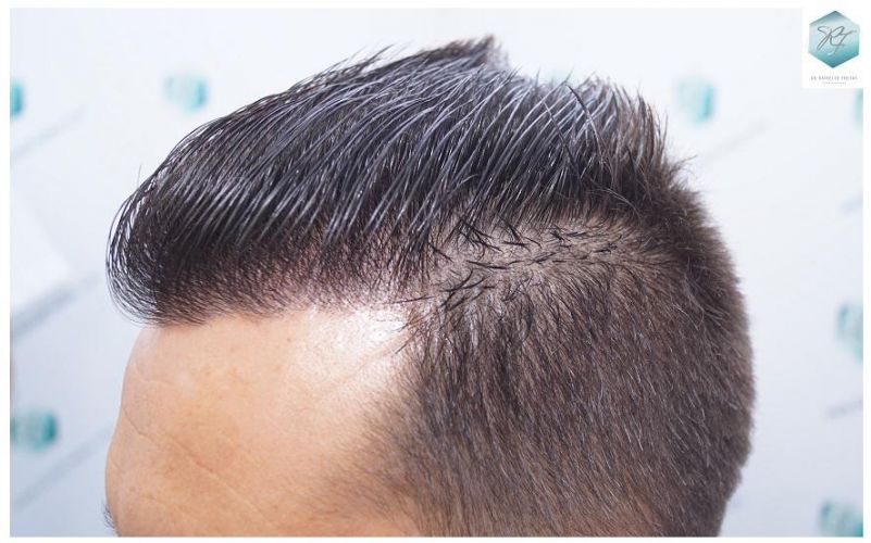 Injerto Capilar Técnica FUE 2762 Grafts (6703 Pelos) 28 trasplante de pelo