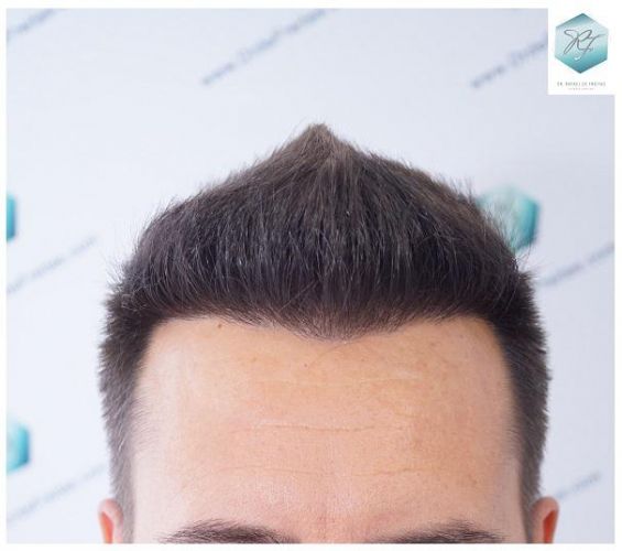 RESULTADOS A LOS 12 MESES trasplante de pelo