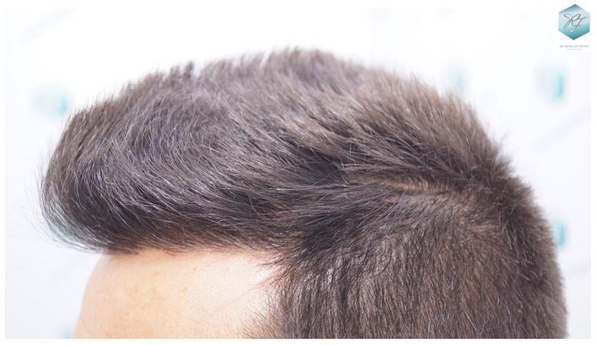 Injerto Capilar Técnica FUE 2762 Grafts (6703 Pelos) 20 trasplante de pelo