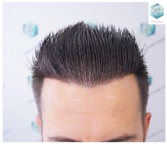 Injerto Capilar Técnica FUE 2762 Grafts (6703 Pelos) 13 trasplante de pelo