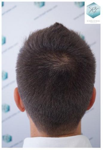 Injerto Capilar Técnica FUE 2762 Grafts (6703 Pelos) 21 trasplante de pelo