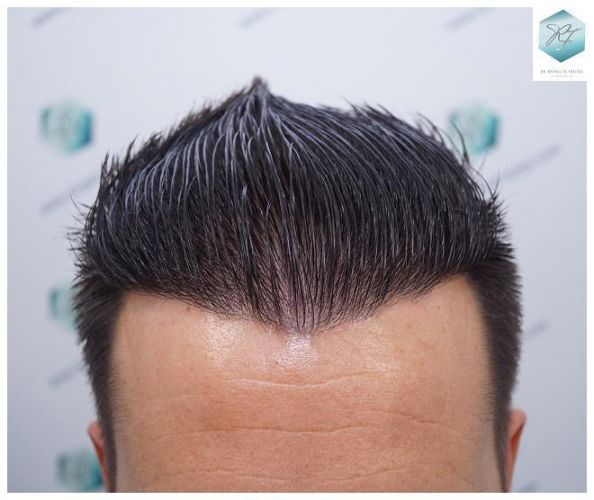 Injerto Capilar Técnica FUE 2762 Grafts (6703 Pelos) 23 trasplante de pelo