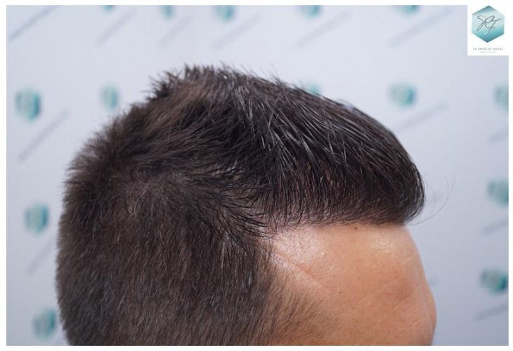 Injerto Capilar Técnica FUE 2762 Grafts (6703 Pelos) 14 trasplante de pelo