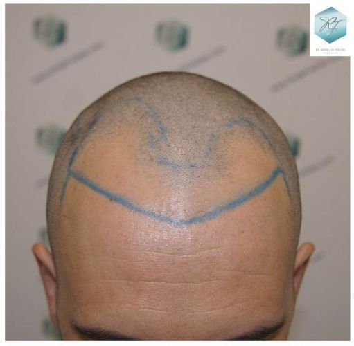 Injerto Capilar Técnica FUE 2762 Grafts (6703 Pelos) 5 recuperar pelo entradas