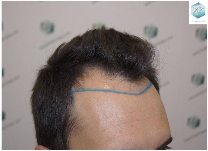 Injerto Capilar Técnica FUE 2762 Grafts (6703 Pelos) 2 trasplante de pelo