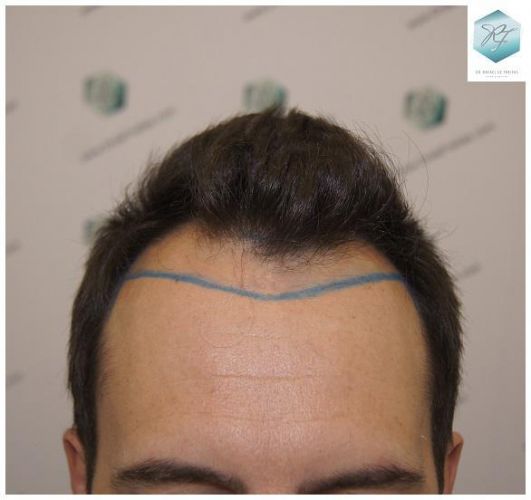 LINEA INJERTO CAPILAR trasplante de pelo