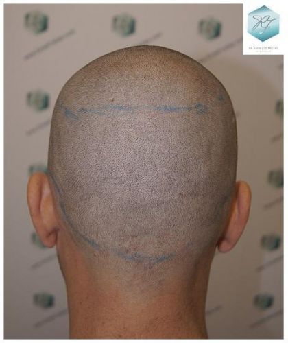 Injerto Capilar Técnica FUE 2762 Grafts (6703 Pelos) 7 trasplante de pelo