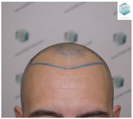 Injerto Capilar Técnica FUE 2762 Grafts (6703 Pelos) 4 trasplante de pelo