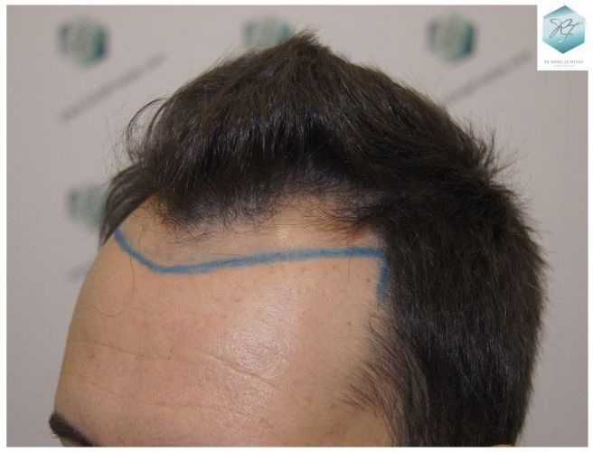 Injerto Capilar Técnica FUE 2762 Grafts (6703 Pelos) 3 trasplante de pelo