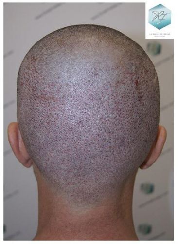 Injerto Capilar Técnica FUE 2762 Grafts (6703 Pelos) 12 trasplante de pelo