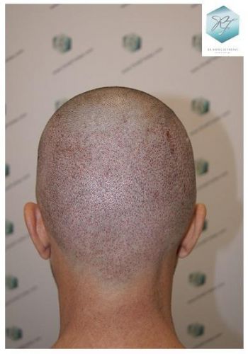 Injerto Capilar Técnica FUE 2762 Grafts (6703 Pelos) 11 trasplante de pelo