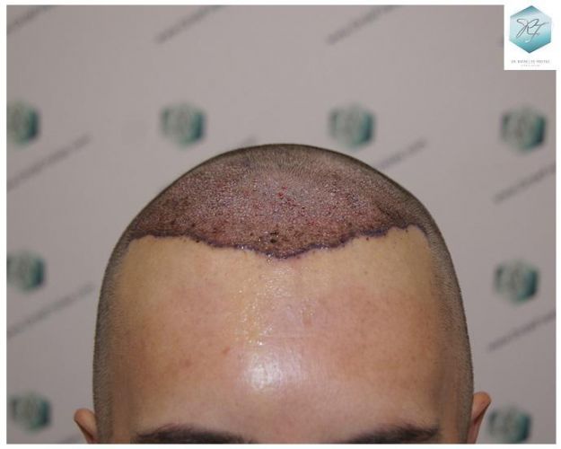 ANTES TRASPLANTE CAPILAR trasplante de pelo