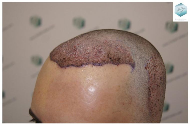 Injerto Capilar Técnica FUE 2762 Grafts (6703 Pelos) 10 trasplante de pelo