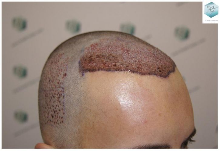 Injerto Capilar Técnica FUE 2762 Grafts (6703 Pelos) 9 trasplante de pelo