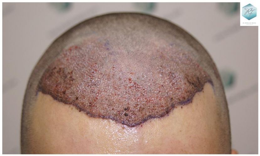 Injerto Capilar Técnica FUE 2762 Grafts (6703 Pelos) 8 trasplante de pelo