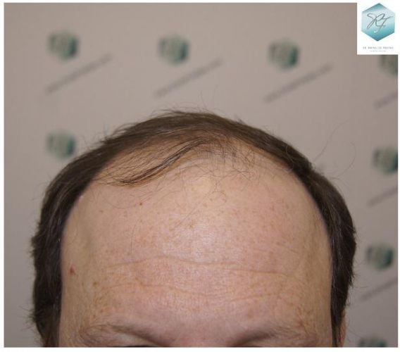 injerto de pelo