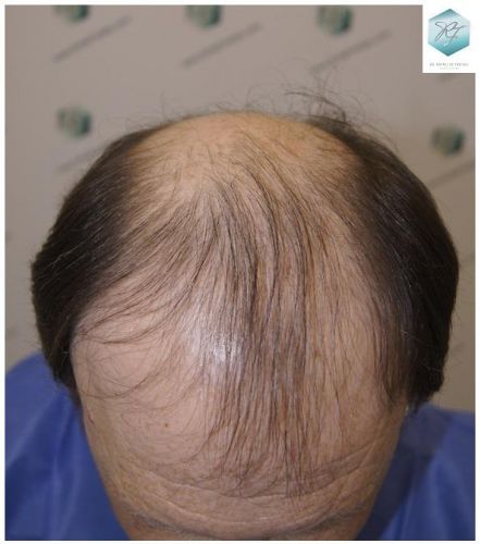 injerto de pelo