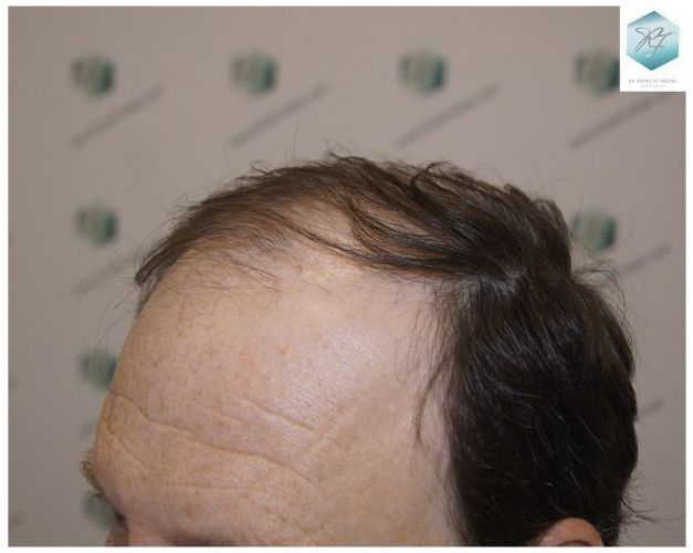 injerto de pelo