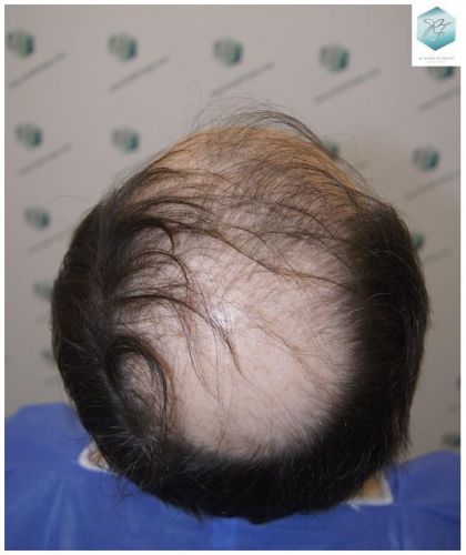 injerto de pelo